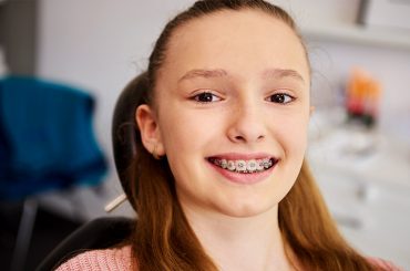 best braces colors