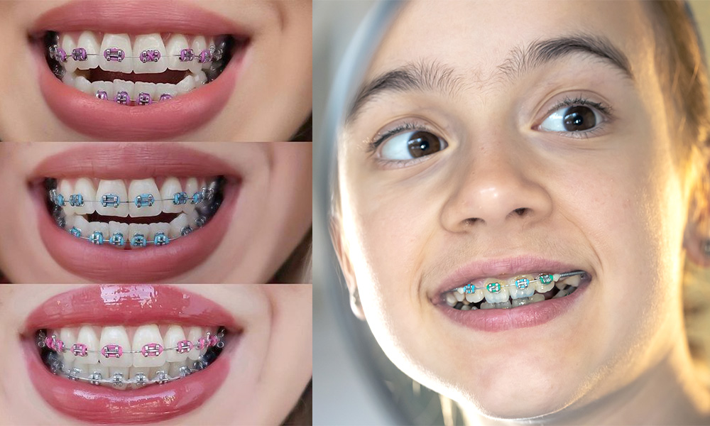 best braces colors